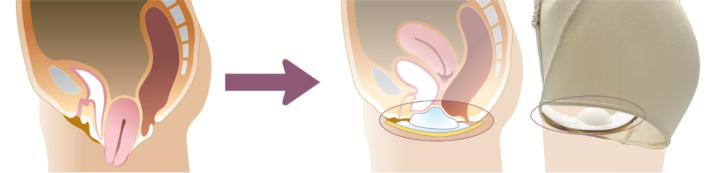 For the treatment and prevention of pelvic organ prolapse