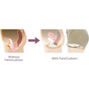 FemiCushion Pelvic organ prolapse